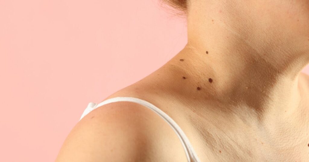 Skin Tags